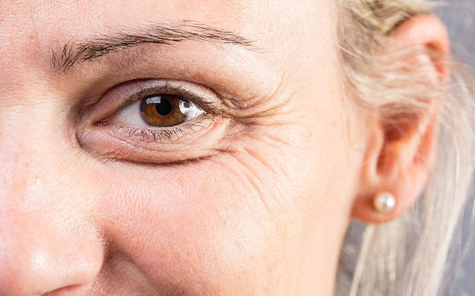 Do you find Crows Feet unattractive?
