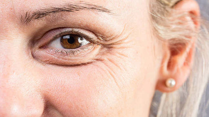 Do you find Crow's Feet unattractive?