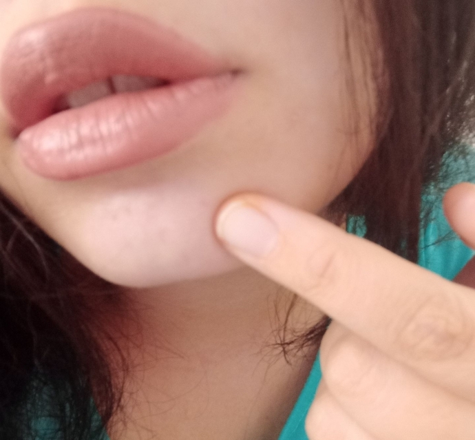 Are the small dots on my chin acne?