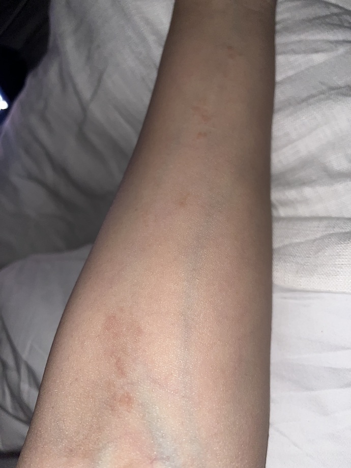 Bumps that don’t go away does anyone know what these are ( pic ) ?