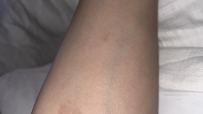 Bumps that don’t go away does anyone know what these are ( pic ) ?