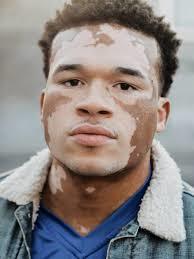 Would you date somebody with Vitiligo?