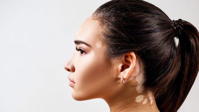 Would you date somebody with Vitiligo?