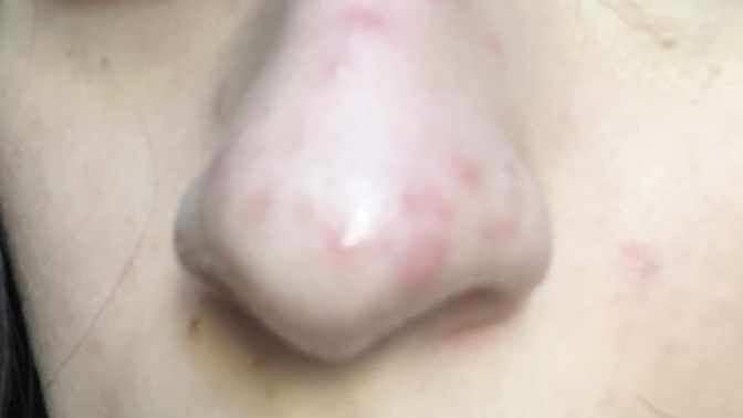 What are these red looking bumps on my nose Acne or perioral dermatitis ( pic ) ?