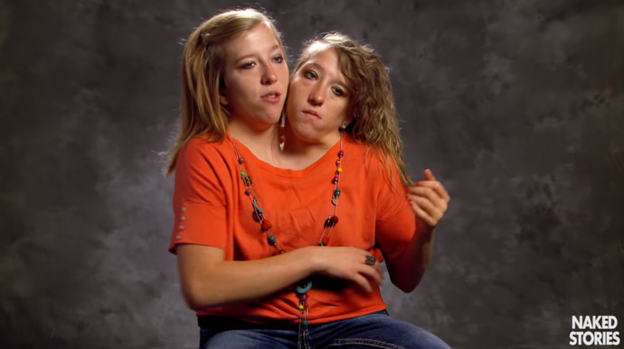 What do you think of this face and hands transplant wedding?