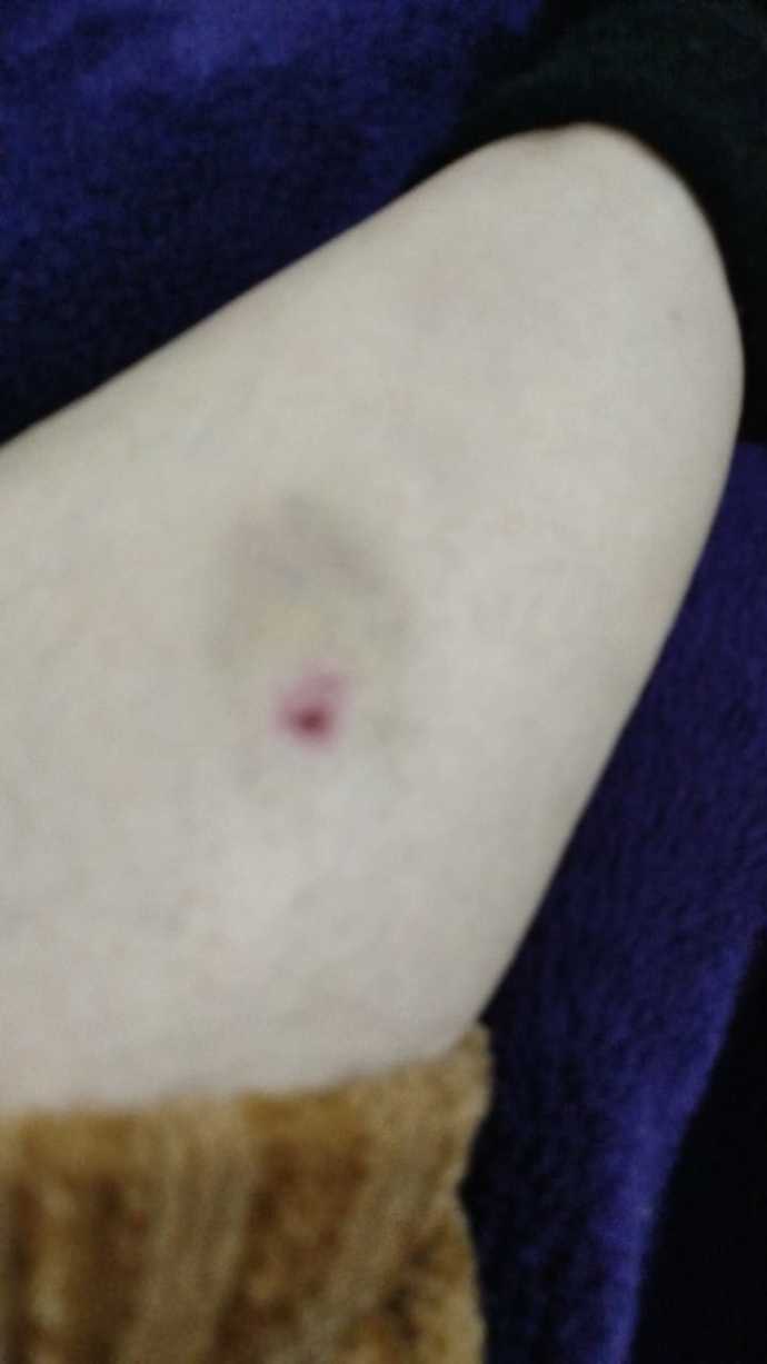 Is this bruise alarming because I didnt get hit by anything its greenish and red please reassure me?