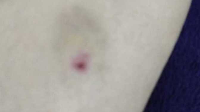 Is this bruise alarming because I didn't get hit by anything it's greenish and red please reassure me?