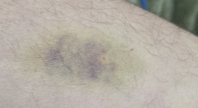 Ever been a combative patient? Restrainer? Witness? Tech did their best for blood draw but 😬 I have NEVER got upset EVER! Theyre tryin to help?