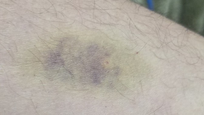 Ever been a combative patient? Restrainer? Witness? Tech did their best for blood draw but 😬 I have NEVER got upset EVER! They're tryin to help?