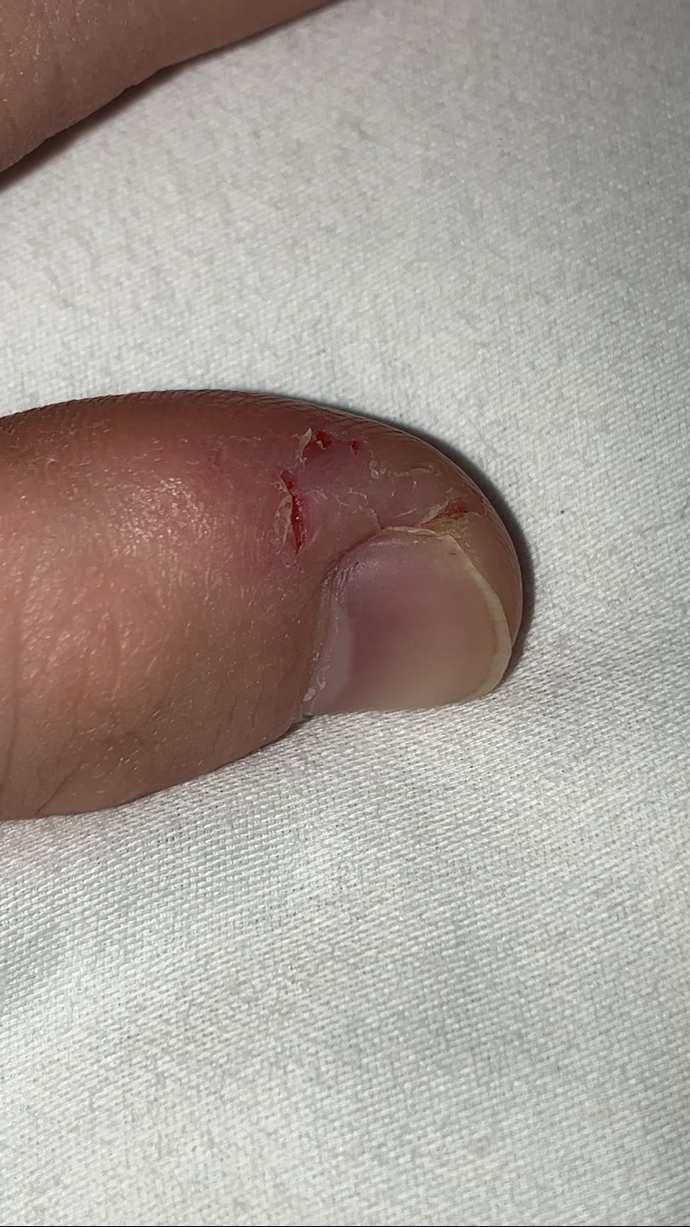 I pick my both fingers thumb skin when I’m anxious how can I prevent this? fidgets don’t work I’m always in pain from it?