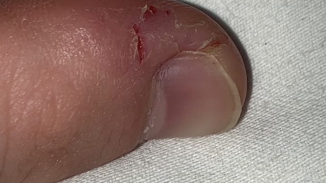 I pick my both fingers thumb skin when I’m anxious how can I prevent this? fidgets don’t work I’m always in pain from it?