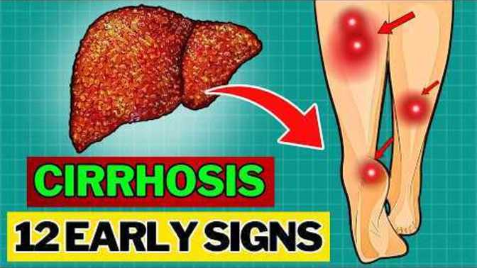 12 Early Signs of Liver Cirrhosis You Can't Ignore. Do you want to know what they are?