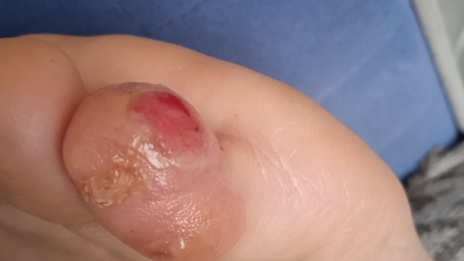How to fix my toe?