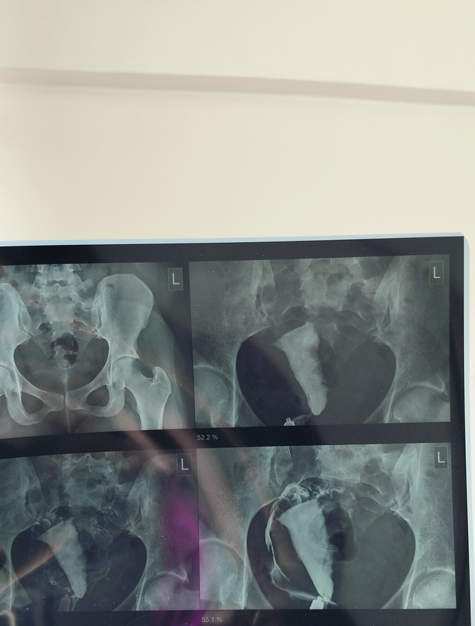 Hsg results? please give your opinions on what you see?