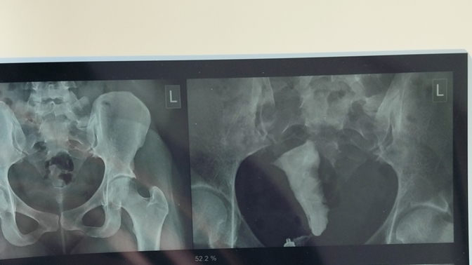 Hsg results? please give your opinions on what you see?