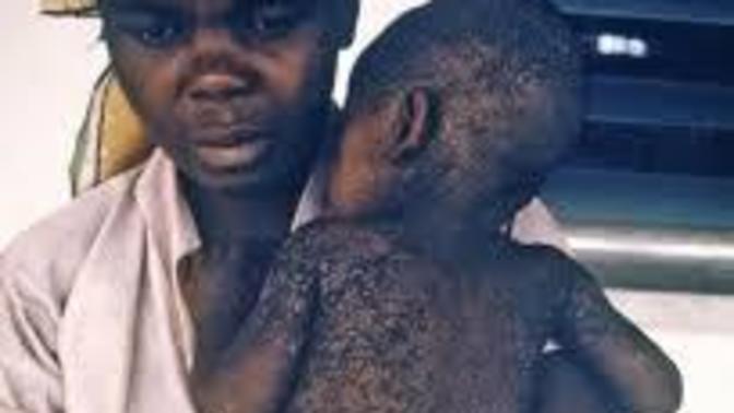 US is on track to have the worst measles outbreak of the century! Are you proud, MAGA?
