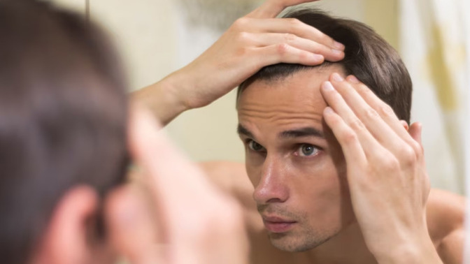 Girls, Are men with receding hairlines unattractive?