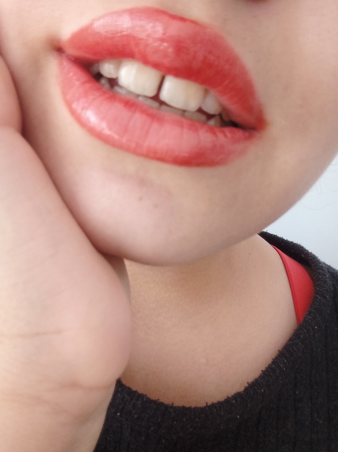 Should I get a filling on the front of my teeth?