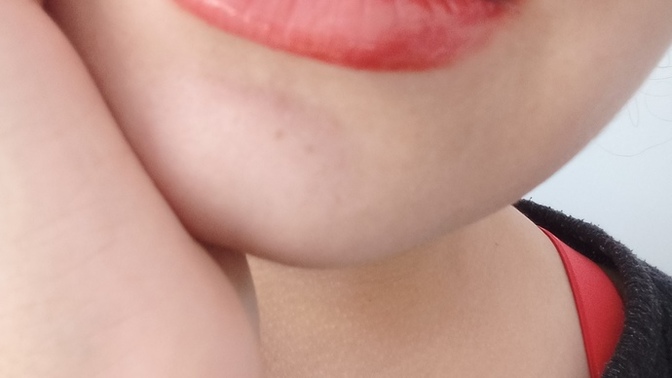 Should I get a filling on the front of my teeth?