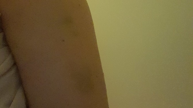 Can RSI cause black bruising?
