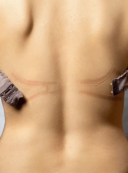 How often bra straps make marks on your back?
