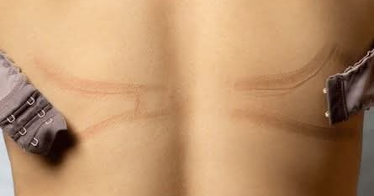 How often bra straps make marks on your back? - GirlsAskGuys