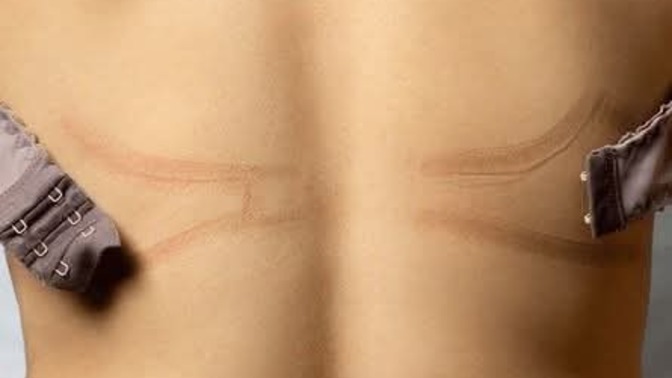 How often bra straps make marks on your back?