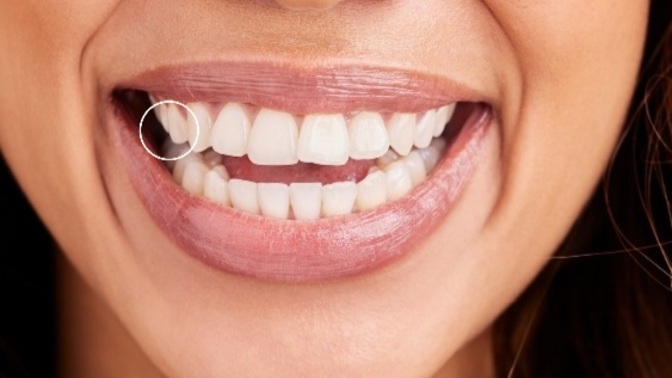 Root canal or pull?