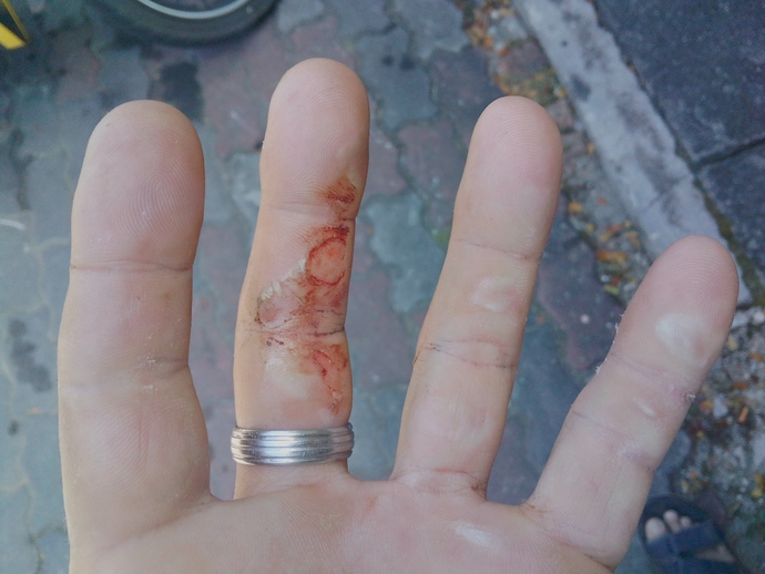 Have you ever suffered a sporting injury. What was it and what sport were you playing?