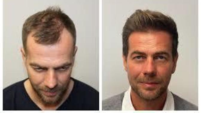 People who believe or know that they are average looking, if you could improve one feature of your looks at no cost or side effects, what would it be?