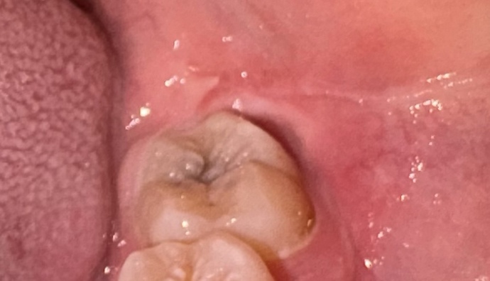 Is this a decayed tooth?