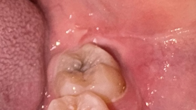 Is this a decayed tooth?