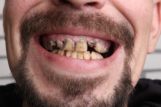 Do someone's teeth matter to you when you are dating?