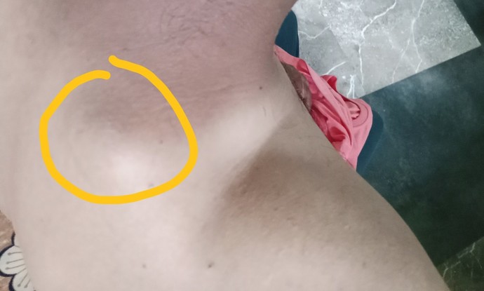 What is that cyst ( knot) on my back neck?
