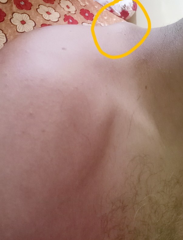What is that cyst ( knot) on my back neck?