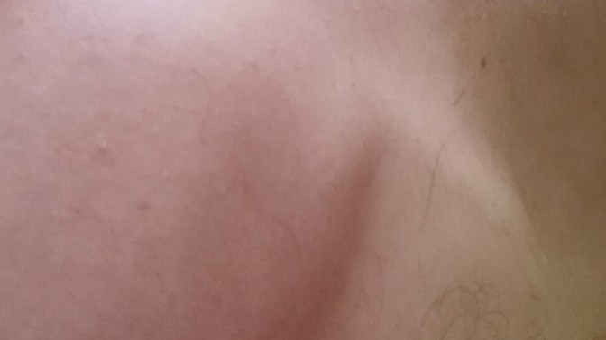 What is that cyst ( knot) on my back neck?