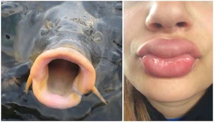 Why do girls think lip filler looks good?