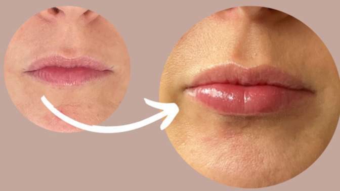 Why do girls think lip filler looks good?