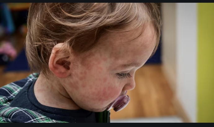 Should parents of children who die from curable measles be held liable?