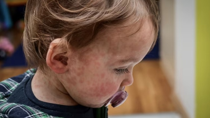 Should parents of children who die from curable measles be held liable?