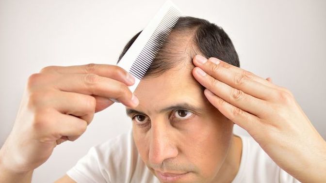If a guy is balding, what do you think looks better?