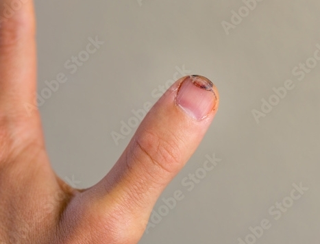 Not My Cut Thumb, just a Sample Picture