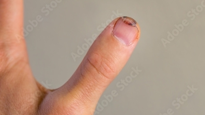 Have you ever CUT your THUMB?
