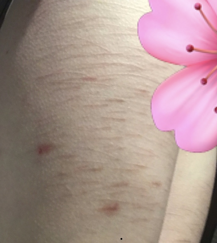 how my thighs look, arms are more faded + not as severe scarring