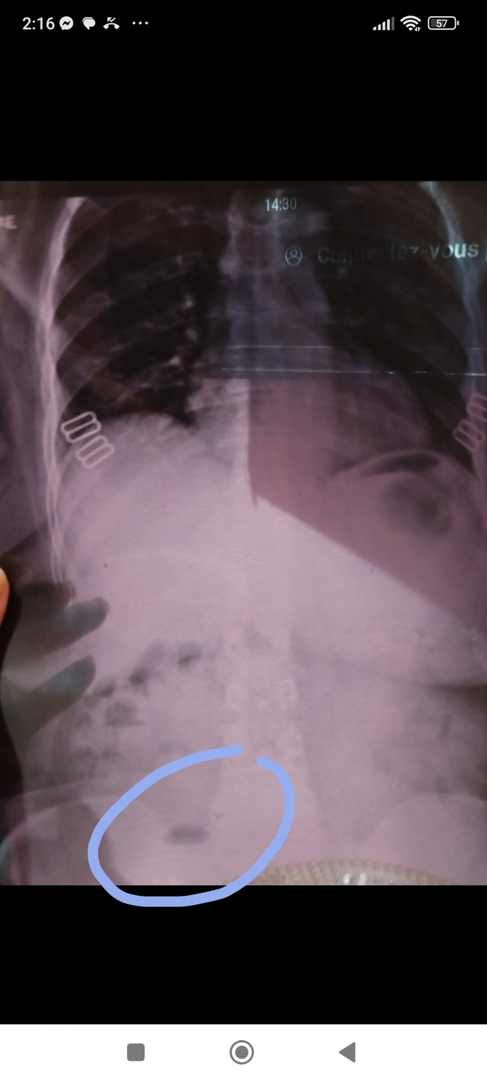 My mom did n x ray image bcz she felt pain in her left side and couldnt enter the toilet what do you think the oval shaped object is? is it serious?