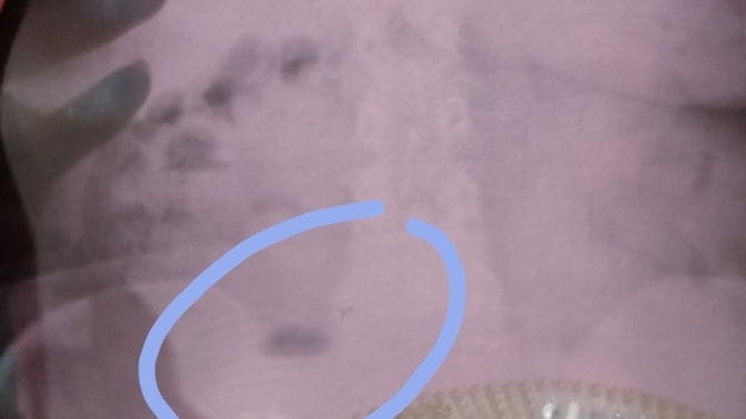 My mom did n x ray image bcz she felt pain in her left side and couldn't enter the toilet what do you think the oval shaped object is? is it serious?