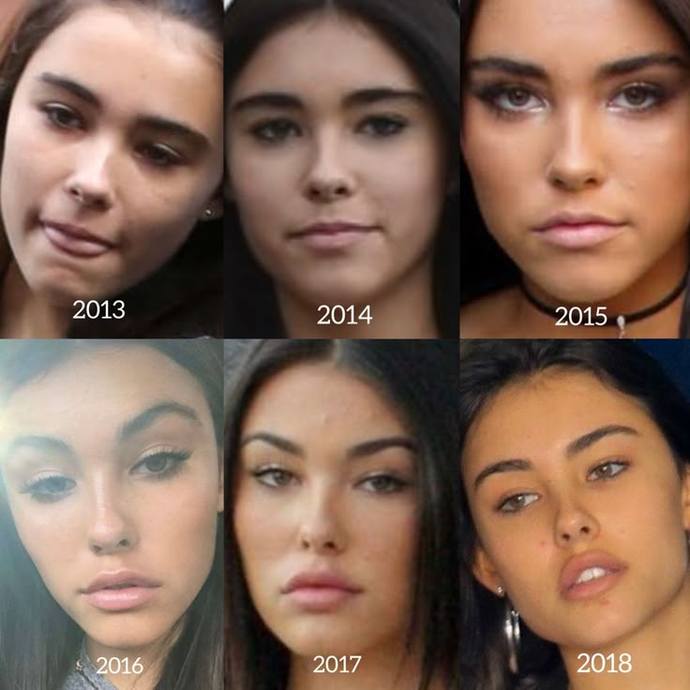 What are your thoughts on Botox and Fillers?