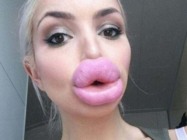 What are your thoughts on Botox and Fillers?