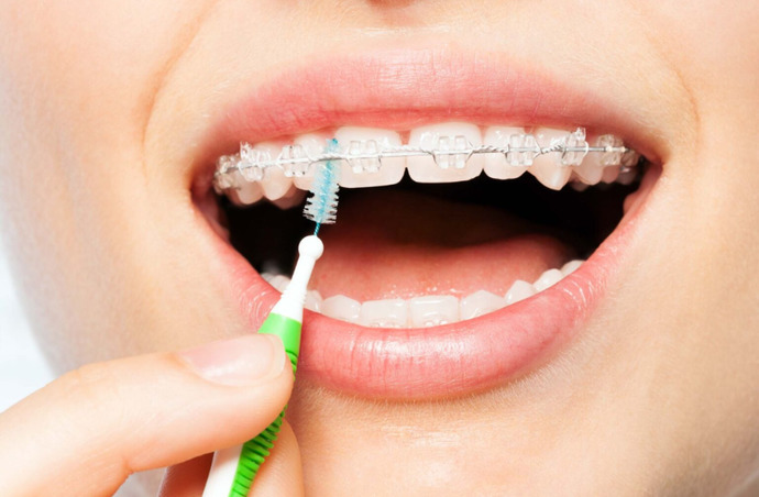 I didnt when I was young. Luckily my teeth werent too bad so I didnt really need them. I did get Invisalign when I was in my t