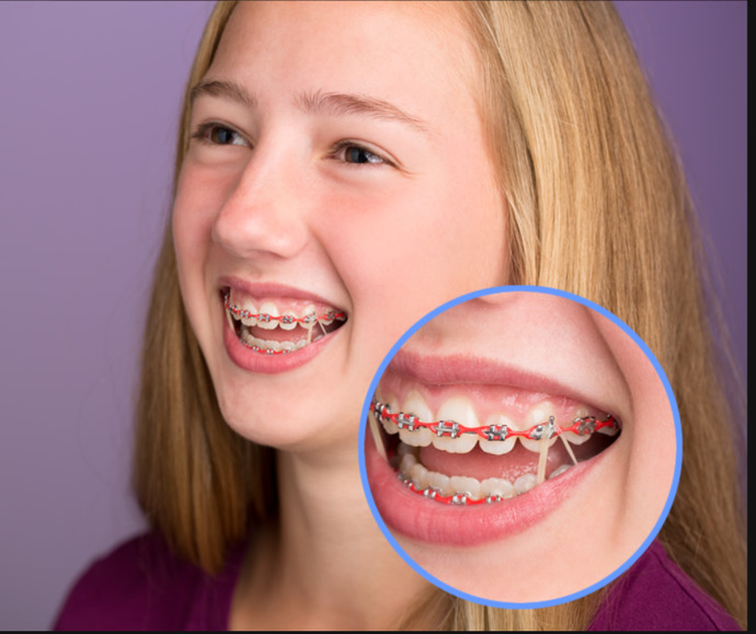 Do you have braces or have you ever had braces?